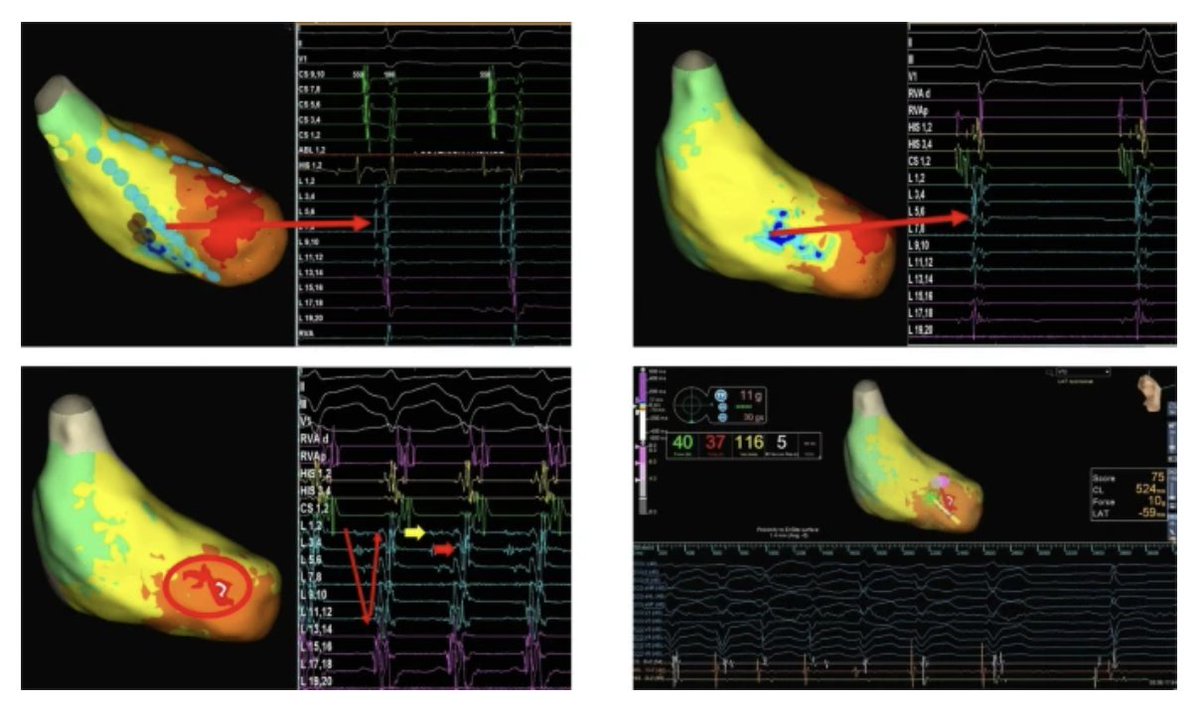JICE_EP's tweet photo. 🚨Latest #FreeRead Article in
@JICE_EP

Use of High Density Electroanatomic Mapping Catheter (Advisor™ HD Grid) in Detecting Critical Purkinje Potentials (P1-P2) in Patients with Left Posterior Fascicular VT

🧐📖https://t.co/Gi77Fl7nfI

by Fadime Koca, Mustafa Lutfullah Ardic, Hasan Koca, Hazar Harbalioglu, Yahya Kemal Icen, Hilmi Erdem Sumbul, Durmus Yildiray Sahin & Mevlut Koc

#EPeeps