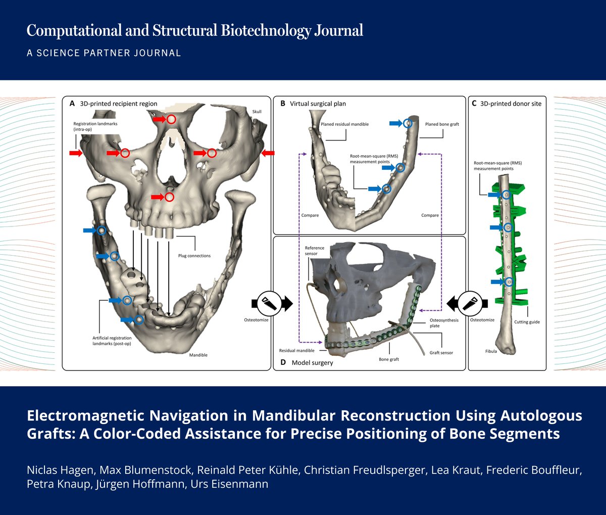 CSB_Journal's tweet photo. 🔗 Electromagnetic Navigation in Mandibular Reconstruction Using Autologous Grafts: A Color-Coded Assistance for Precise Positioning of Bone Segments. https://t.co/nB7N5WjlJ3

📚 CSBJ Smart Hospital: https://t.co/zWiNZlDqzv

@CSB_Journal @SPJournals @aaas  #MaxillofacialSurgery https://t.co/hYTym4jrKc
