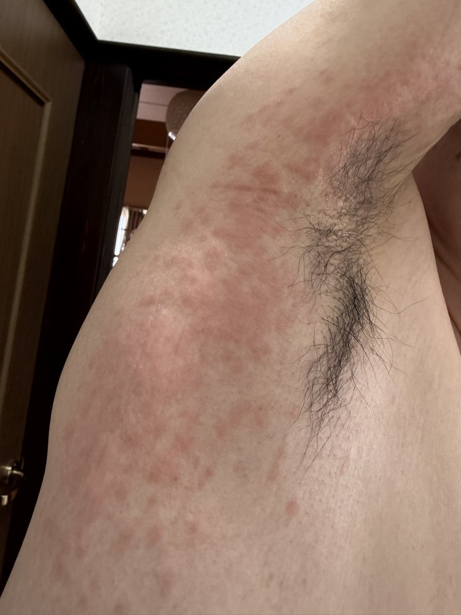 utasyokunin's tweet photo. 【やっちまった‼️💦】
昨日、半袖でりんごの木を剪定→今朝、右脇〜腕が猛烈な痒み＆真っ赤😱
どうやら毛虫の毒針毛か⁉️
薬を飲み、塗って、冷やして対処中。
洗濯物も全部お湯で洗い直し、任務完了‼️
剪定は長袖・手袋必須ですね🐛
「あー痒い‼️」 https://t.co/8mIVYfDMrs