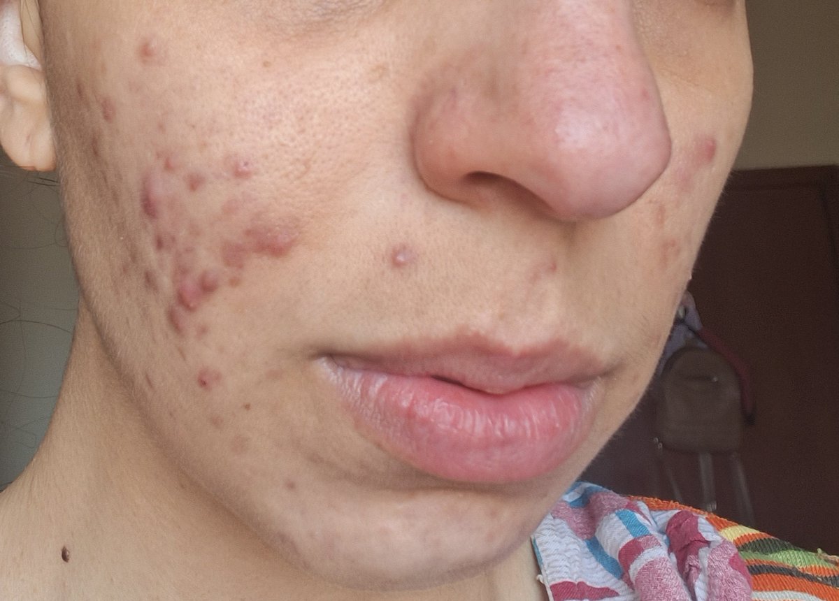 EstellaAmaBTS's tweet photo. Minha pele com o genérico mais barato doa roacutan e depois do tratamento minha pele nunca mais deu espinha https://t.co/HvtAX4tHwR