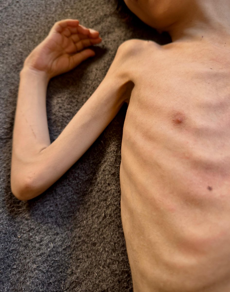 UNRWAes's tweet photo. "Hemos contabilizado más de 21.000 niños y niñas con malnutrición aguda en #Gaza" @Raquel_Marti_ para @COPE
El hambre no debería de ser un arma. BASTA YA.
👇
https://t.co/6pxL6eogsu https://t.co/dulsBsYwaG