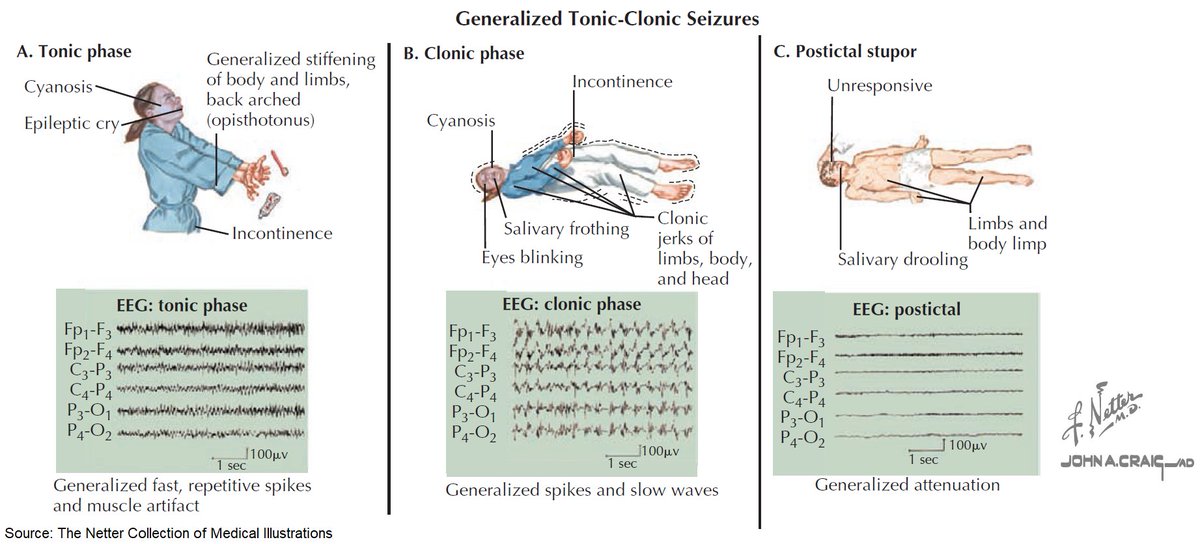 ManualOMedicine's tweet photo. Clinical Presentation of Generalized Tonic-Clonic Seizures

#medtwitter #foamed #usmle https://t.co/Fd9gyrPHPH