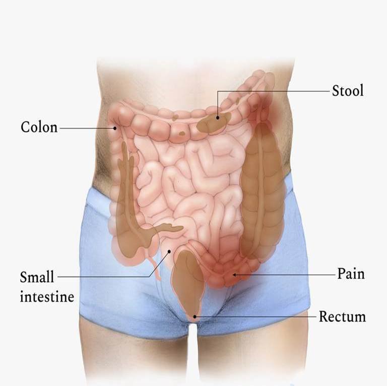 Sainte_Hermine5's tweet photo. Vous vous sentez lourd, ballonné et la constipation vous gâche la vie ?

Pas de panique. Oubliez les médicaments agressifs : voici le remède miracle de nos grands-mères, 100 % naturel et ultra-efficace pour vider le ventre en douceur.

On décrypte.🧵 https://t.co/3PZ7DpXoRx