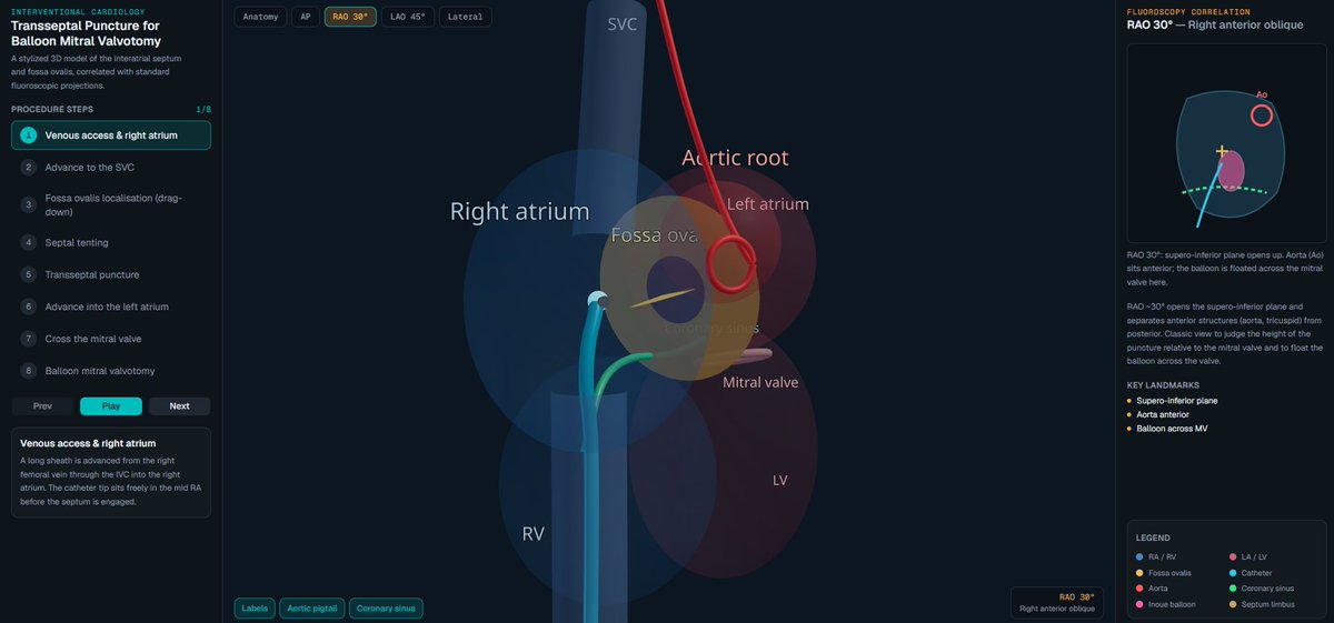dreamer_henil's tweet photo. @ashebytes It's truly amazing. I have tried to create a model for mitral valve anatomy and TSP, which are among the most complex structures. https://t.co/DPxm6RNpTh