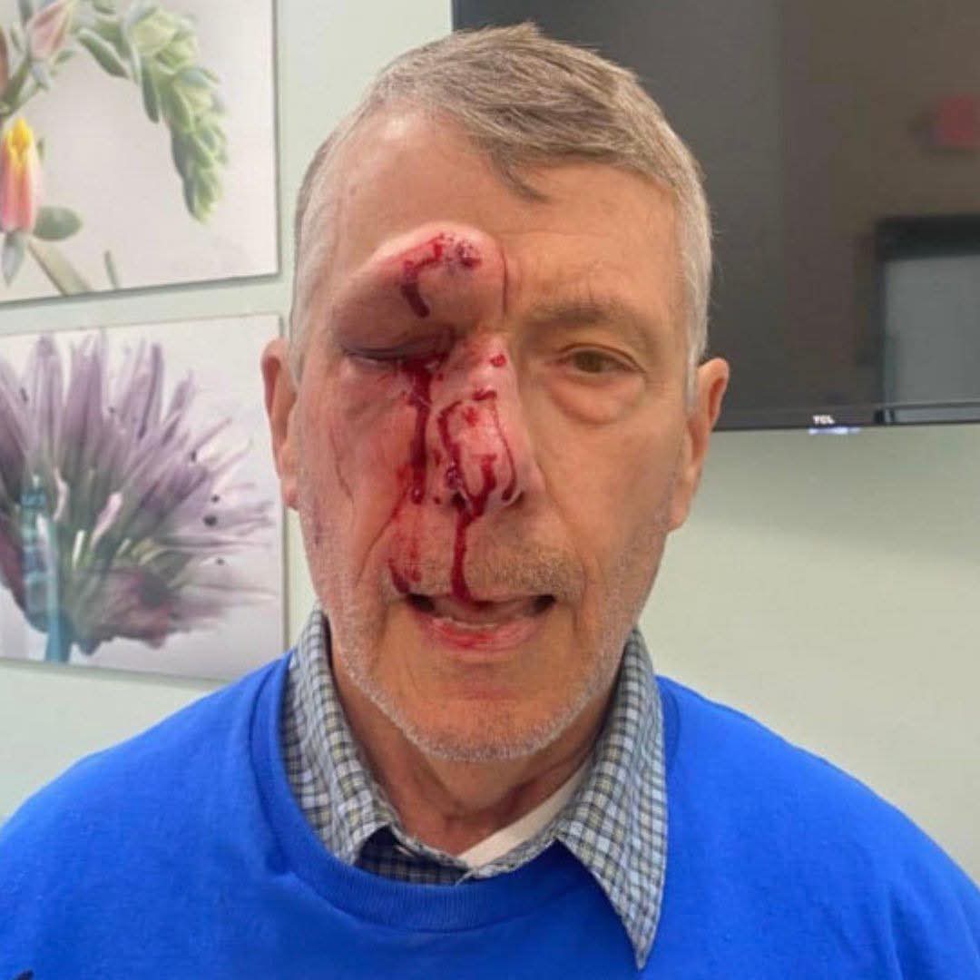 DavidJHarrisJr's tweet photo. Mark Crosby is a pro-life advocate who was brutally attacked outside Planned Parenthood. His attacker has received NO JAIL TIME for this crime.

Mark suffered a shattered eye socket, severe head trauma, and temporary blindness in one eye. His attacker has been sentenced to home arrest and three years of probation.

If the roles were reversed, would the sentence have been different?