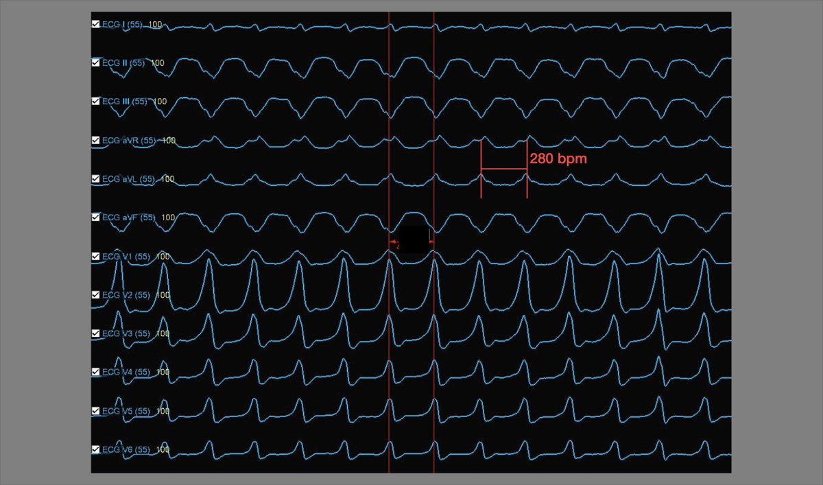 HaroldRivner's tweet photo. Used Tactiflex Duo first time (*Investigational Use Only)
TCL 215 ms - 280 bpm
Midmyocardial/Epicardial Scar
Endocardial Ablation Only
No longer Inducible https://t.co/k07mbvu9V6