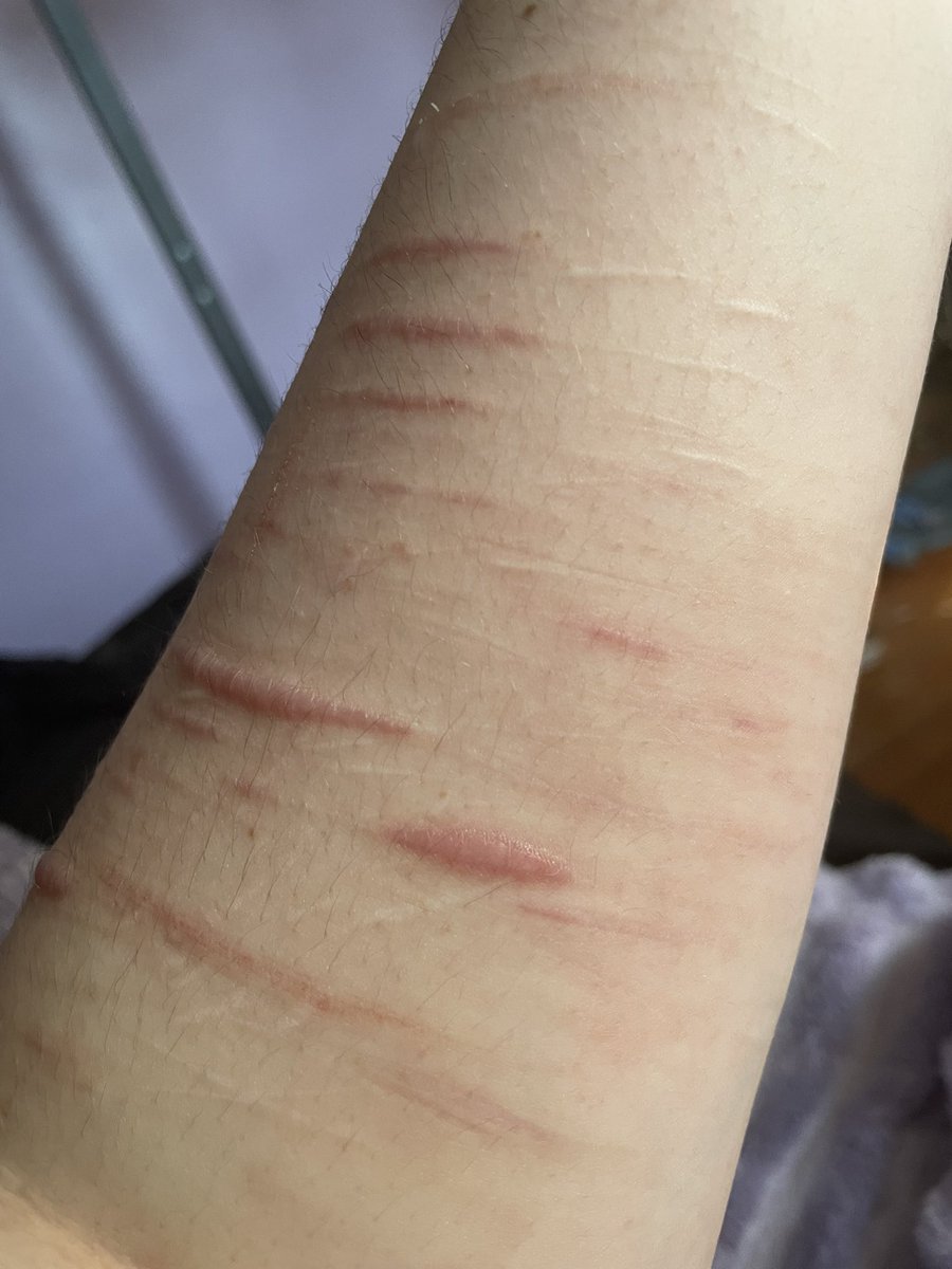 eclxpseswhxre's tweet photo. healed scars, don’t cut urself guys!!
#988twt #scarmakeup #scartwt https://t.co/tfe3ctl7ym