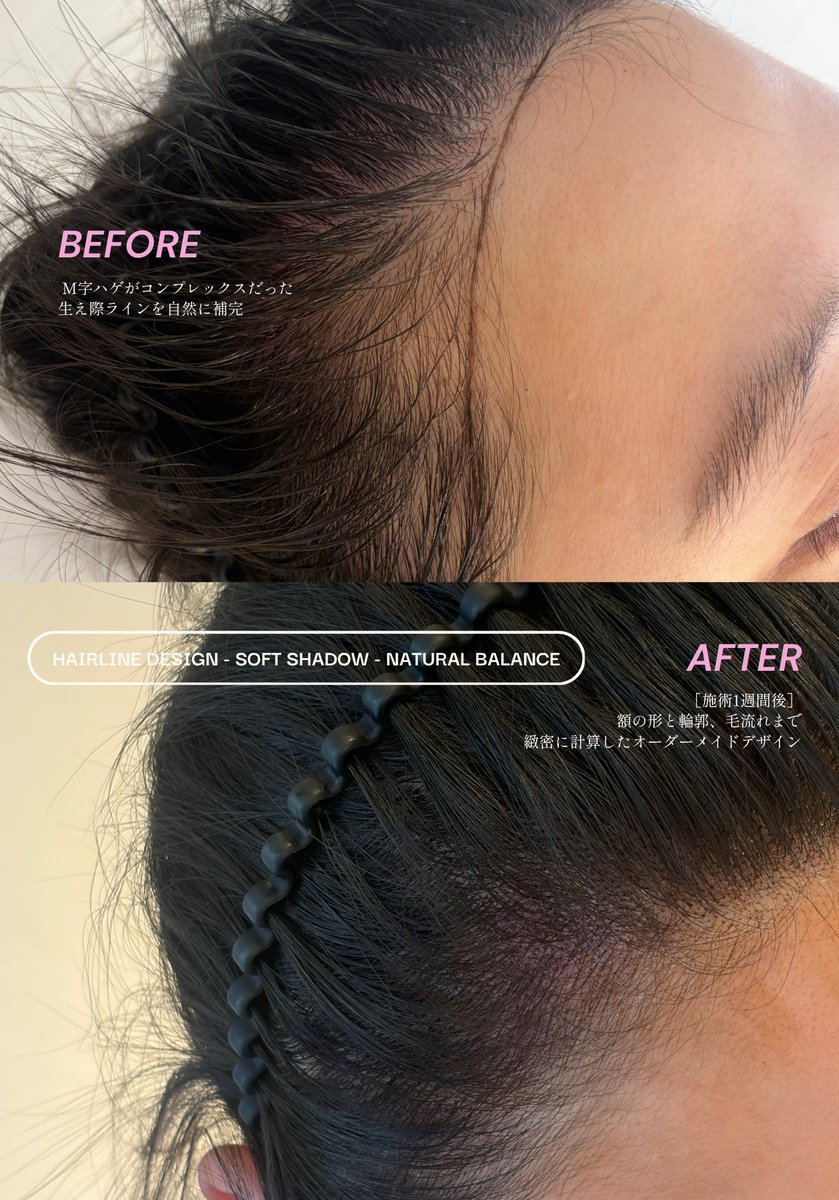 elessi_lash's tweet photo. ヘアラインアートというと、かつらのように境界線が不自然になるんじゃないの？と思われる方も多いですが当サロンで施術を受けられたお客様は、みなさん「地毛みたい！」と驚いて帰って行かれます。毎朝一生懸命シェーディングする時間も短縮できて満足度1位🏅の施術を一度体験してみてください🎀 https://t.co/VdSBEs4tkC
