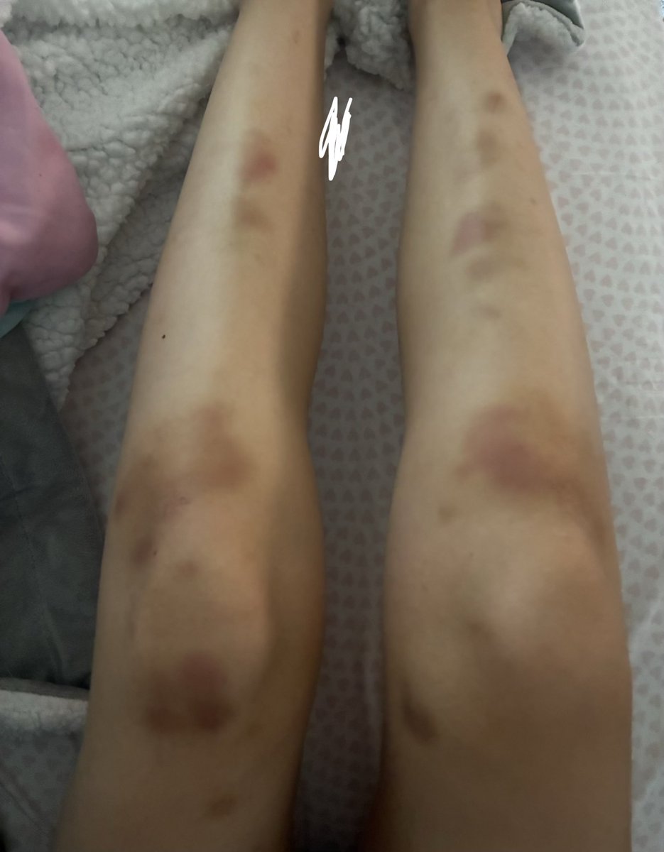 prettykitlily's tweet photo. bruise https://t.co/XwKxq4OQTm
