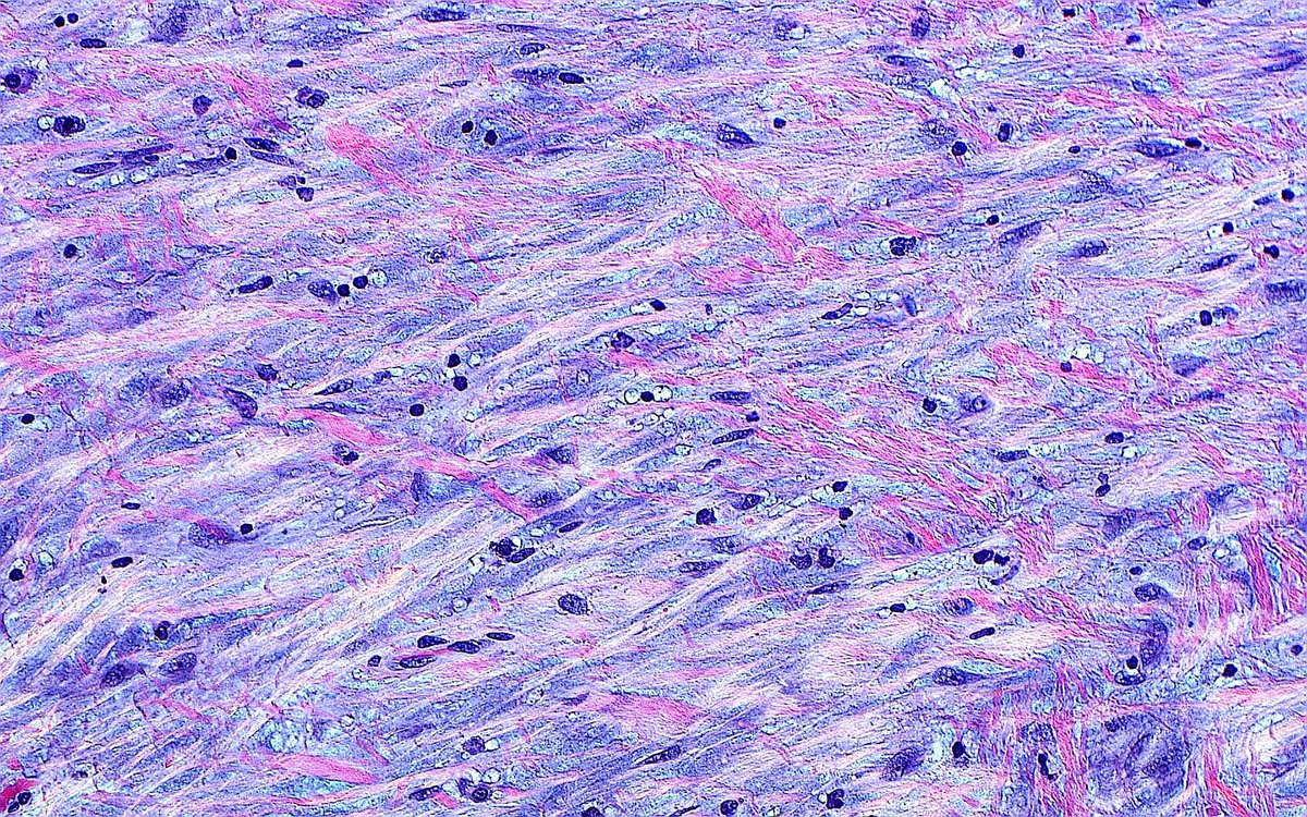 ziad_zaatari's tweet photo. 🔬📸 "Brushstrokes" 🖌️🎨 ~ Fibrous tissue in desmoplasia ~ #Pathology #Histology #PathArt https://t.co/t8vwgipRDO