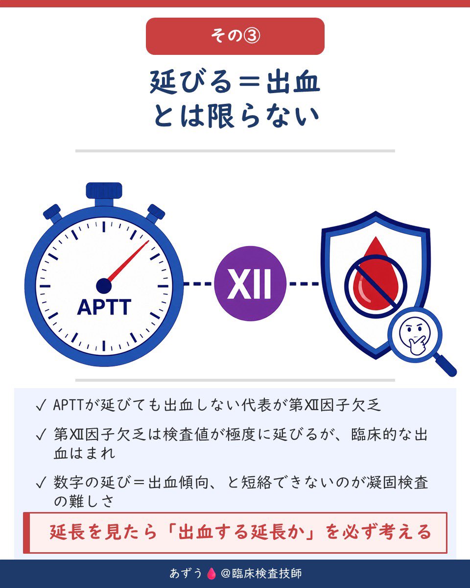 az_mt111's tweet photo. 🩸 PT・APTTの読み方｜延長パターンで原因を絞る

「APTTがかなり延びている…これって出血する？」

凝固検査では、数字の延長だけで判断するのは危険です。
大切なのは「PTとAPTTのどちらが延びているか」と「なぜ延びているか」🔬

PTとAPTTは、凝固カスケードの別々の入り口を見ています。

🔴 PT＝外因系＋共通系
🔵 APTT＝内因系＋共通系

この違いを知っておくと、延長パターンから原因をかなり絞れます。

🔴 PTだけ延長
→ 第Ⅶ因子異常、ワルファリン初期、ビタミンK欠乏の初期

🔵 APTTだけ延長
→ 第Ⅷ・Ⅸ・Ⅺ・Ⅻ因子異常、血友病、ヘパリン、ループスアンチコアグラントなど

🟣 PT・APTTともに延長
→ 共通系因子の異常、DIC、重症肝障害など

ただし重要なのが、

⚠️「凝固時間が延びる＝出血しやすい」とは限らないこと。

代表例が第Ⅻ因子欠乏。
APTTが大きく延長しても、臨床的な出血はまれです。

つまり見るべきなのは、単なる「秒数」ではなく、その延長が本当に出血につながるものなのかということ。

そしてAPTT延長の正体をさらに絞るのが、クロスミキシング試験です🧪

📉 下に凸 → 因子欠乏を疑う
📈 上に凸 → インヒビターを疑う

第Ⅷ因子インヒビターでは、37℃・2時間加温後の遅延反応も重要です。

さらに、採血量不足によるクエン酸比率のズレやヘパリン混入でもAPTTは偽性延長します。

👉「PT？APTT？両方？」
👉「出血する延長？」
👉「因子欠乏？インヒビター？」
👉「そもそも検体は大丈夫？」

この順番で考えると、凝固検査の数字の“裏側”が見えてきます🩸