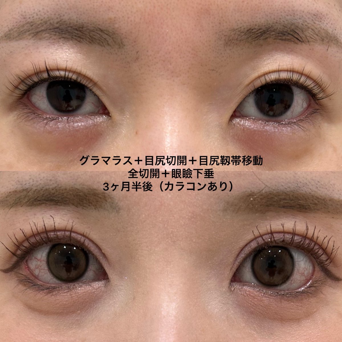 eternalprince08's tweet photo. 上下目切開症例

・過去に二重埋没法を受けられたものの、もっと内側から食い込みの深い二重になりたい
・全体的に目を大きくしたい
上記ご希望で施術を行いました

#エターナルクリニック
#二重切開
#たれ目形成 https://t.co/ru1oKf7bXC