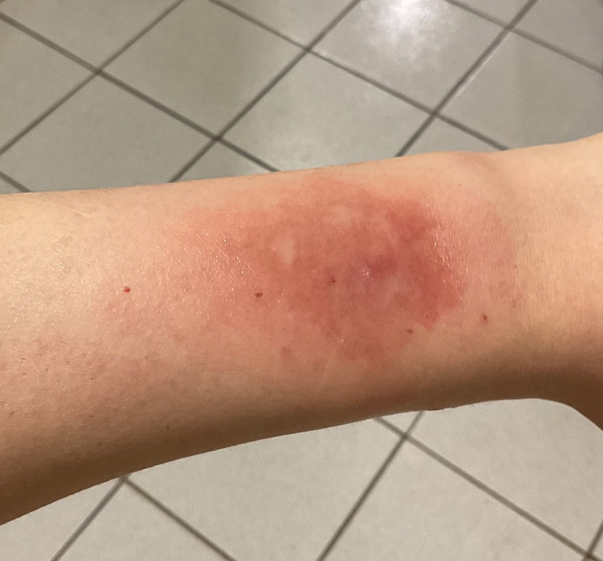 Murasame_Yui's tweet photo. キャビネットを移動中に負った傷が蜂窩織炎に進行し、現在治療を受けている https://t.co/9YgkKPSBct