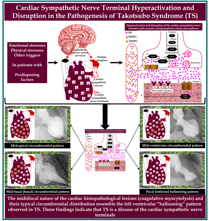 RCMjournal's tweet photo. 🫀 Takotsubo syndrome may be more than a “broken heart”.

Often associated with emotional or physical stress, Takotsubo syndrome is a complex condition with incompletely understood mechanisms.

This review explores the potential role of cardiac sympathetic nerve terminals in the pathogenesis of Takotsubo syndrome.

👇 A thread
#Cardiology #TakotsuboSyndrome
