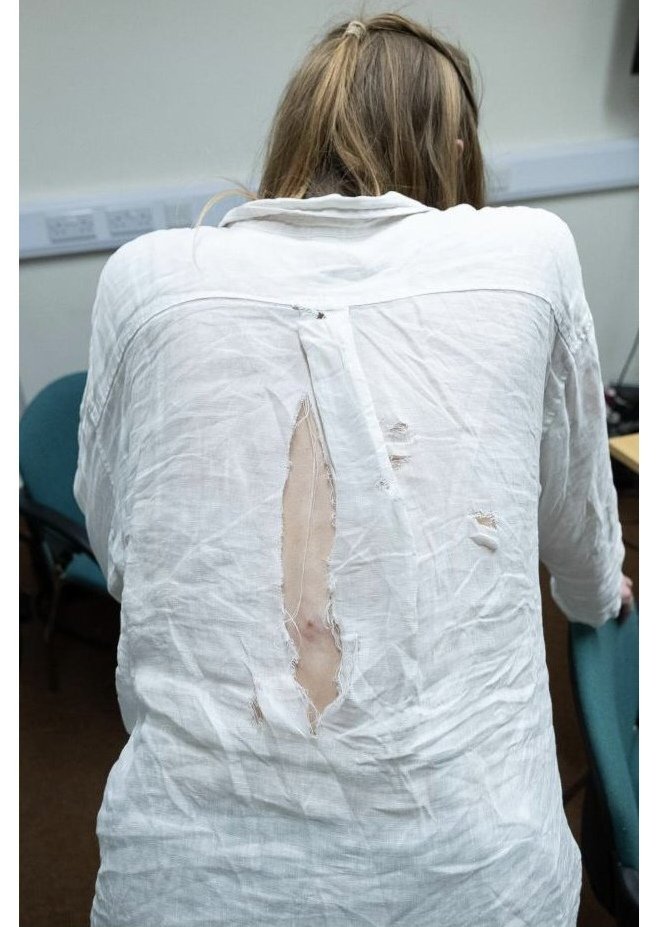 RespectIsVital's tweet photo. These are some of the injuries sustained by the female protester who was violently removed from the Reform Confrence.

Is it really "Boo Hoo" @RobertJenrick ? Is this acceptable to you?

You still thinking about a "whip round" for the man who struck her @LeeAndersonMP_?

Grim https://t.co/hXNcv0mb8i