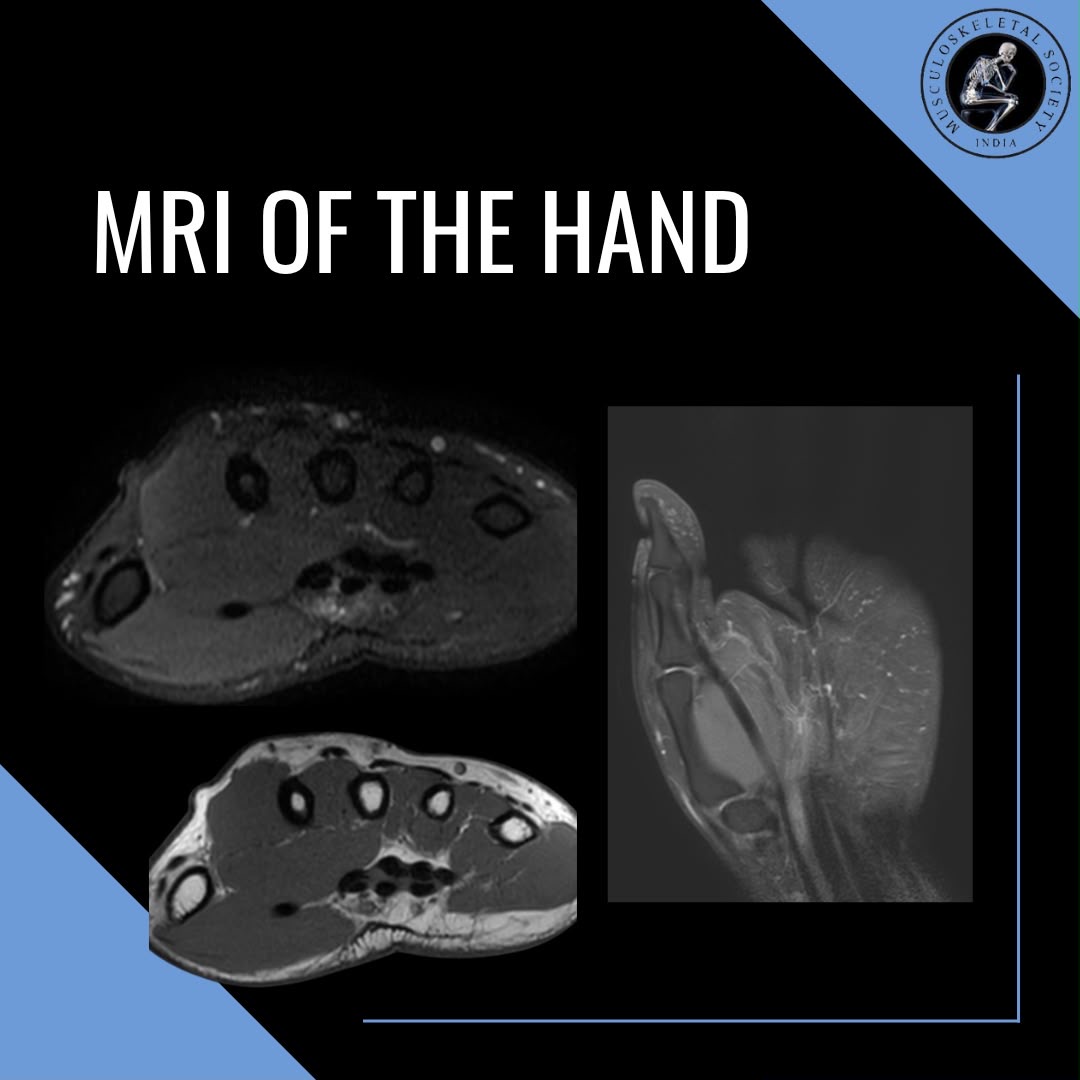 MSKSocietyIndia's tweet photo. MSS COTW #3
-Dr. Shayeri Roy Choudhury

29 yr old weight-lifter and smoker with pain in mid palmar region, focal tenderness in proximal palm.

MRI showed mild localized non-specific PDFS hyperintensity in the median nerve in carpal tunnel.

Contd in 🧵…

#mss #msk #mskrad #ortho https://t.co/nVNoHDSOIb