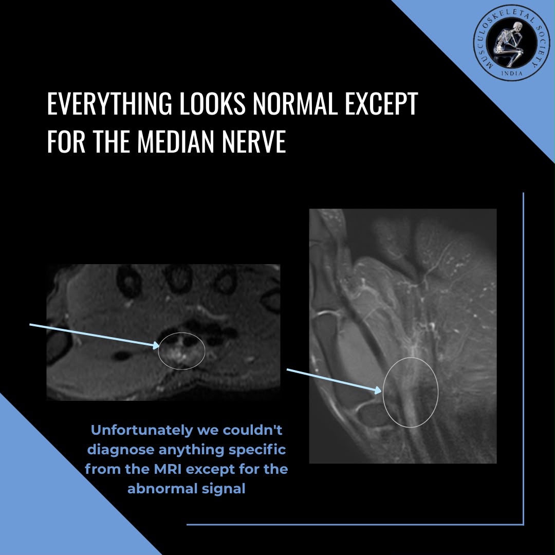 MSKSocietyIndia's tweet photo. MSS COTW #3
-Dr. Shayeri Roy Choudhury

29 yr old weight-lifter and smoker with pain in mid palmar region, focal tenderness in proximal palm.

MRI showed mild localized non-specific PDFS hyperintensity in the median nerve in carpal tunnel.

Contd in 🧵…

#mss #msk #mskrad #ortho https://t.co/nVNoHDSOIb