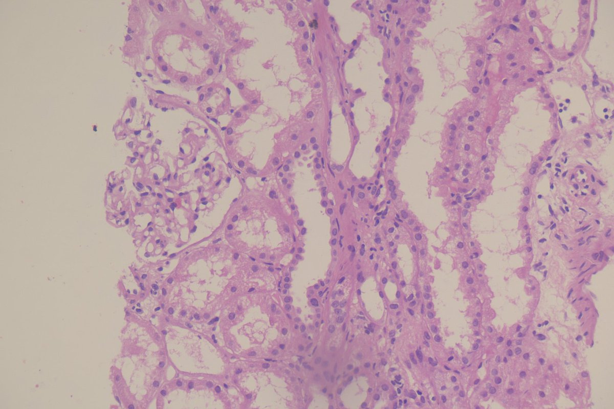RenalPathLabs's tweet photo. Subtle things can be missed!
What do u think this is??
#Nephpath #AskRenal #PathTwitter #RenalPath #SubtleCases https://t.co/F9TAe5FczL