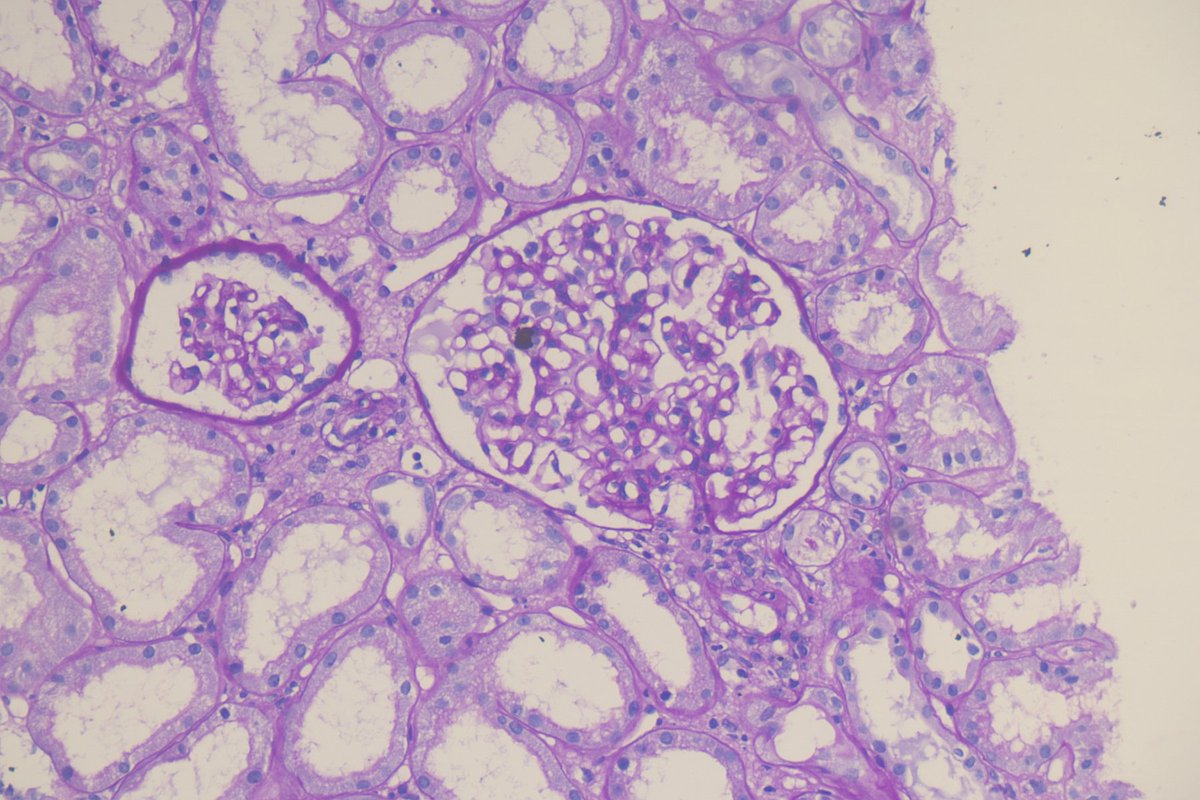 RenalPathLabs's tweet photo. Subtle things can be missed!
What do u think this is??
#Nephpath #AskRenal #PathTwitter #RenalPath #SubtleCases https://t.co/F9TAe5FczL