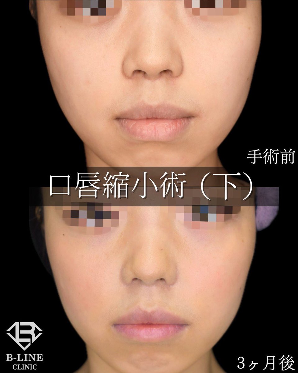 dr_koikeyasu's tweet photo. 【口唇縮小術(下)】
手術3ヶ月後  ⭐️モニター価格12万〜⭐️

厚ぼったい下唇も存在感が無くなるように、ここまで自然にスッキリさせることができます✨
単純に切除・縮小するのではなく、緻密に形をデザインして形成しています！
ミリ単位での調整とデザインのセンスが必須ですので、経験豊富な美容外科専門医にお任せ下さい😌
唇の他院修正や、ご希望の形にしたいと当院を受診される方が多いです。