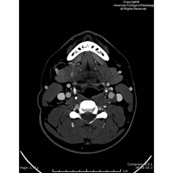 RadiologyACR's tweet photo. A 27-year-old male presents with acute onset of sharp pain along the left superior neck, beginning 5 days prior. #ACRCaseinPoint https://t.co/5cqdGEDRvX https://t.co/EY48sjz8iP