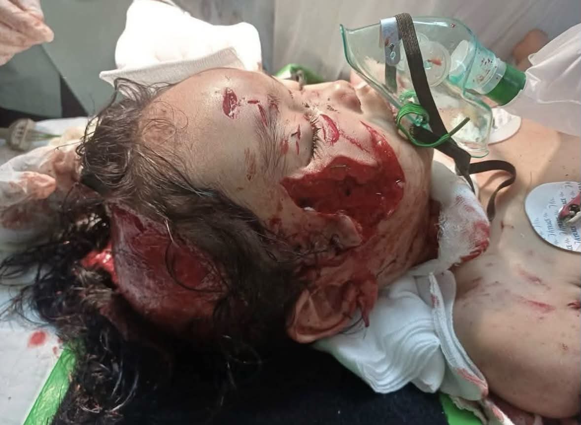 kamaghul's tweet photo. Nur Haira Watikah Mohammad Hamizi, 2, parah dipercayai digigit anjing liar di hadapan rumahnya di Kampung Tambak, Sungai Kelambu, Peserai, di sini, pagi semalam

Kredit daripada azmi ismail https://t.co/MzCHCSBsxd