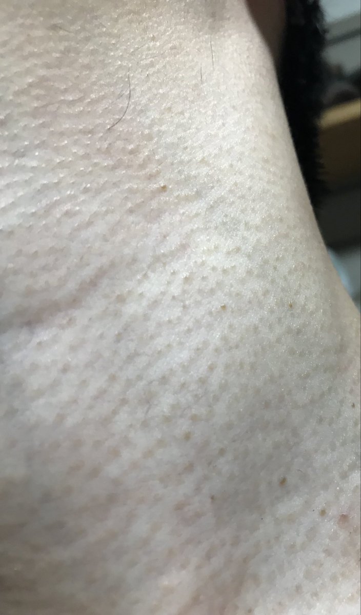 punch_mind_'s tweet photo. 拾い画なんですが、私もコレ。
首から鎖骨にかけてブツブツ。
毛穴？汚れ？
どうした改善する？ https://t.co/CpAA89INkA