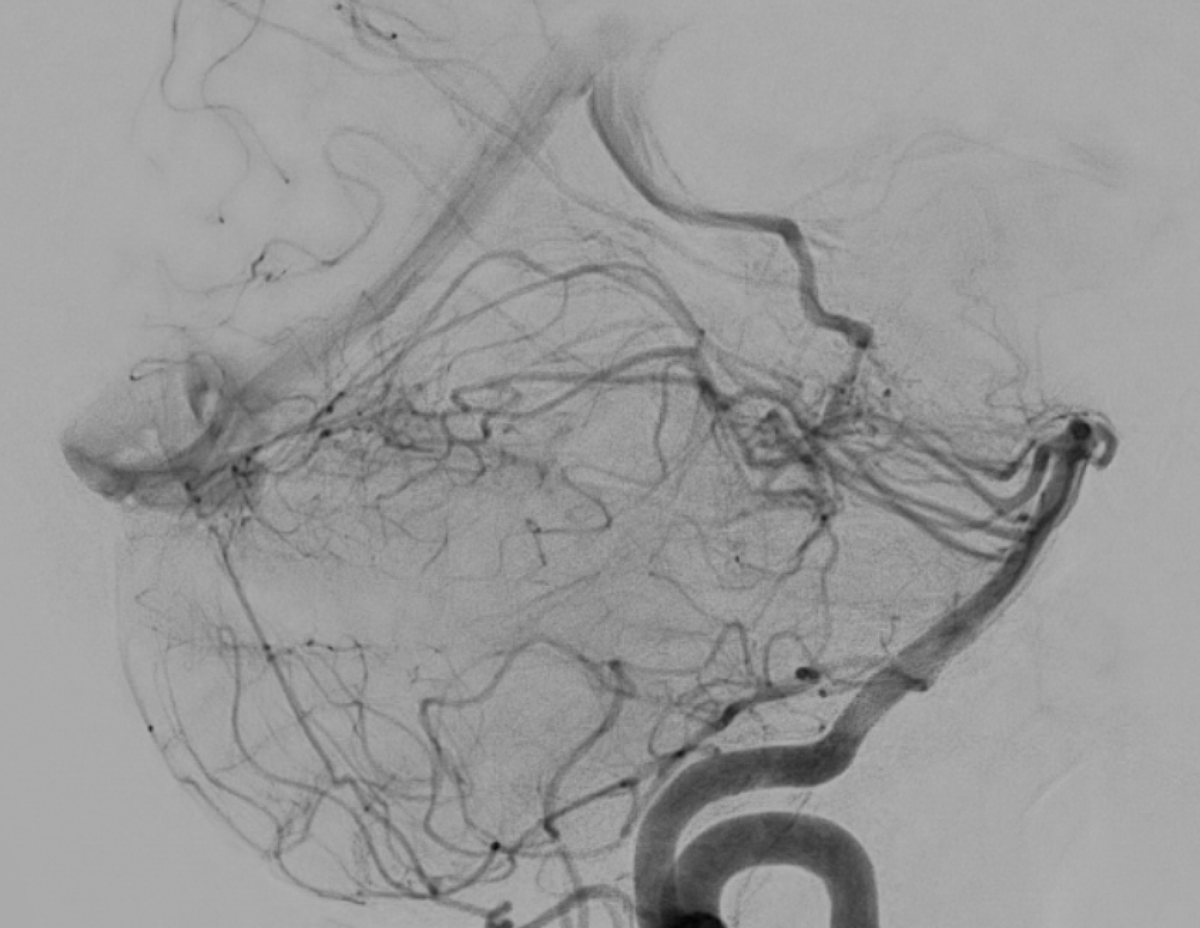 jjgarnham's tweet photo. Acute non-traumatic cerebellar haemorrhage in a young patient. Nothing seen on the CT angiogram or the post-contrast MRI, but look at the ASL...

There's high signal in the occipital sinus; this is not normal. If veins light up on ASL, that means labelled arterial blood got there too fast, which usually means it skipped the capillary bed. This implies arteriovenous shunting!

Lo and behold, the DSA shows a left perimesencephalic arteriovenous malformation supplied by basilar perforators and branches from the left superior cerebellar artery, draining into the left basal vein, vein of Galen, and straight sinus.