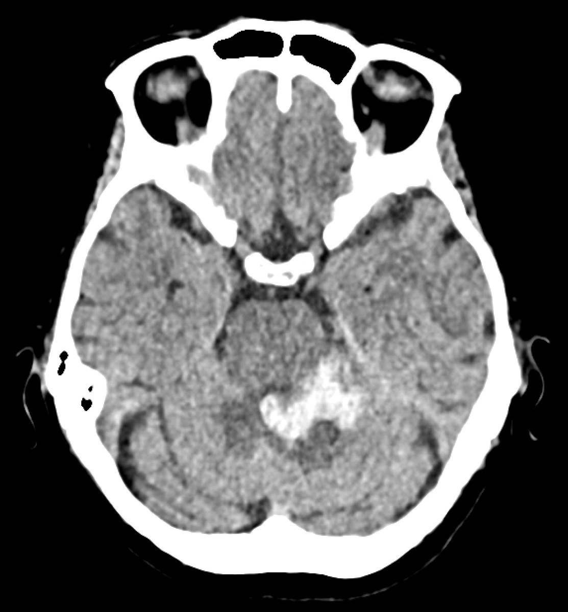 jjgarnham's tweet photo. Acute non-traumatic cerebellar haemorrhage in a young patient. Nothing seen on the CT angiogram or the post-contrast MRI, but look at the ASL...

There's high signal in the occipital sinus; this is not normal. If veins light up on ASL, that means labelled arterial blood got there too fast, which usually means it skipped the capillary bed. This implies arteriovenous shunting!

Lo and behold, the DSA shows a left perimesencephalic arteriovenous malformation supplied by basilar perforators and branches from the left superior cerebellar artery, draining into the left basal vein, vein of Galen, and straight sinus.