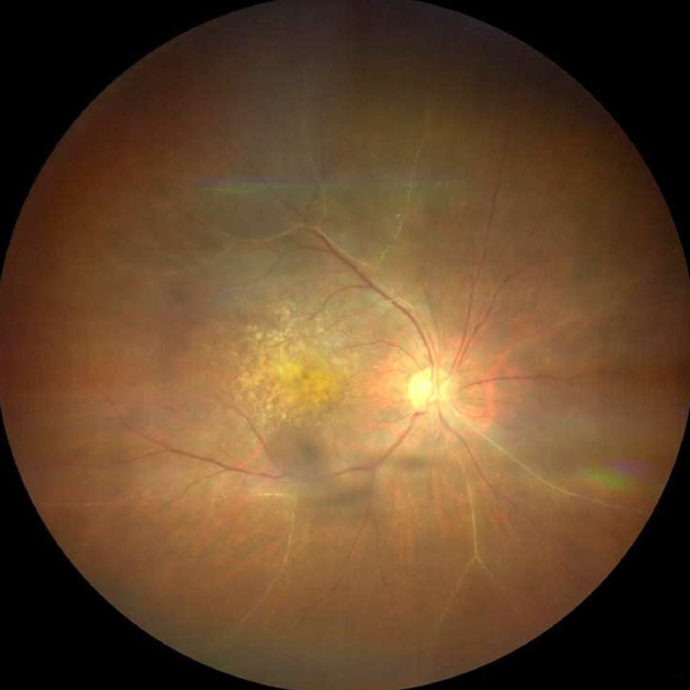 revoptom's tweet photo. Retinal Vasculitis Signs Emerge Across Intravitreal Therapies

FAERS data reveal post-marketing reports with anti-VEGF and complement inhibitor injections; brolucizumab accounted for the largest share.

https://t.co/04K1ZmV22m

#optometry #eyecare #retinaldisease #treatment https://t.co/JnloP4mJYW