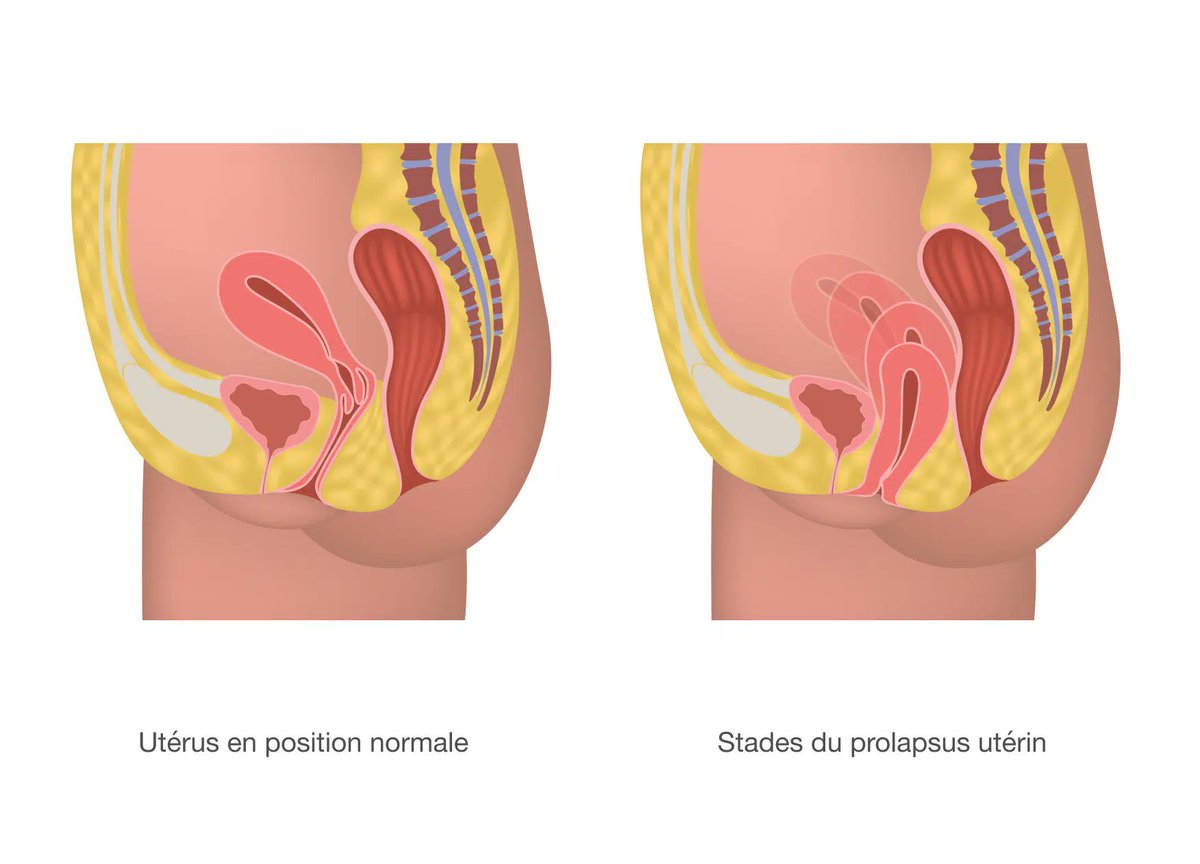 FalloppioGyn's tweet photo. Le prolapsus utérin = l’utérus qui descend dans le vagin.

Ça arrive quand les muscles et ligaments du plancher pelvien lâchent (accouchements, âge, ménopause, constipation chronique, etc.).

C’est très courant : 30 à 50 % des femmes présentent un certain degré de prolapsus au cours de leur vie, et environ une femme sur deux après 50 ans a au moins un stade léger à l’examen. Beaucoup n’osent pas en parler.

Il n’y a aucune honte. C’est un problème mécanique, pas une fatalité.

La bonne nouvelle : la prise en charge est efficace. Rééducation périnéale, pessaire ou chirurgie (souvent peu invasive aujourd’hui) permettent de retrouver du confort.

N’attendez pas. Parlez-en à un gynécologue, une sage-femme ou un kiné spécialisé.