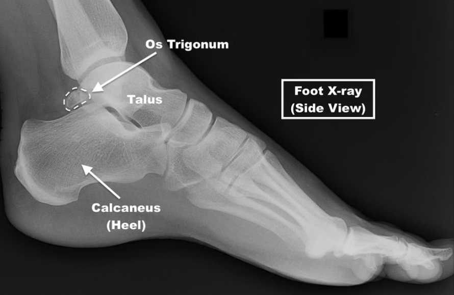 byanatomist's tweet photo. 🏸❓❔❓ The small bone behind the talus is:
A) Avulsion fracture
B) Os trigonum
C) Loose body
D) Calcified Achilles tendon

Comment your idea 👇 https://t.co/amiE3F3VcS