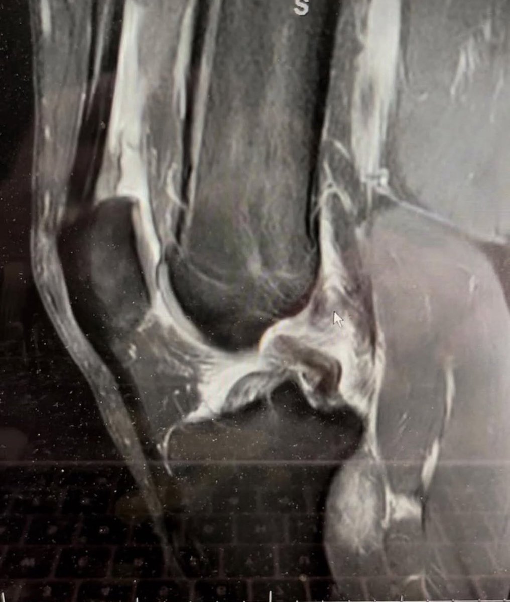 drkevinwilk's tweet photo. 👉 Professional football player got a medial blow (or hit on medial knee causing a varus load) to his knee while making a tacklepain &amp; unable to walk on it👉 knee swelling later in that day 🤔 what do you think is wrong?👉 Share your thoughts &amp; diagnosis below! #knee #kneeinjury https://t.co/pQhquThCIx