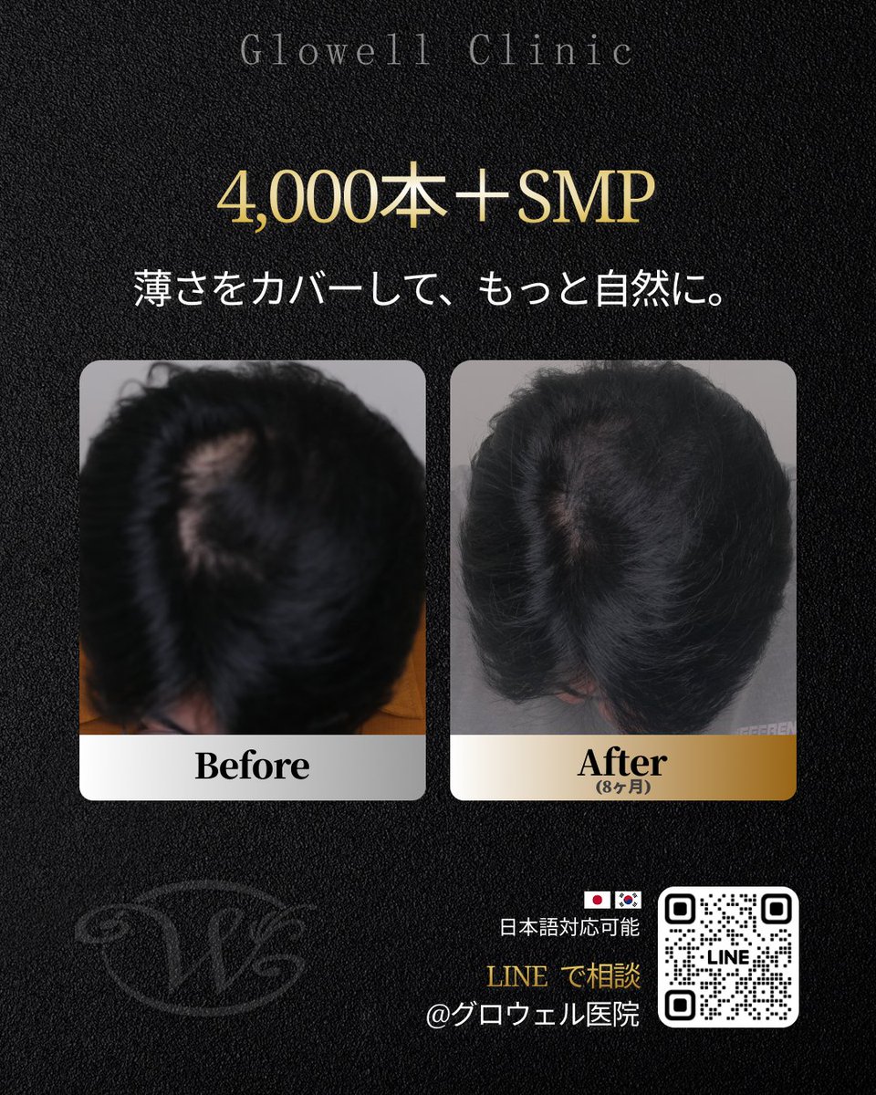 gwl26319900's tweet photo. 分け目の透け感、まだ気になっていませんか？👀

4,000本植毛＋SMPで
分け目から頭頂部までしっかりカバー✅

見た目の密度感を高めて、
より自然な印象へ🙌

📍韓国・汝矣島 グロウェル医院
🌐日本語対応可能

#韓国植毛 #SMP #分け目植毛 https://t.co/2XYDz9FP4c
