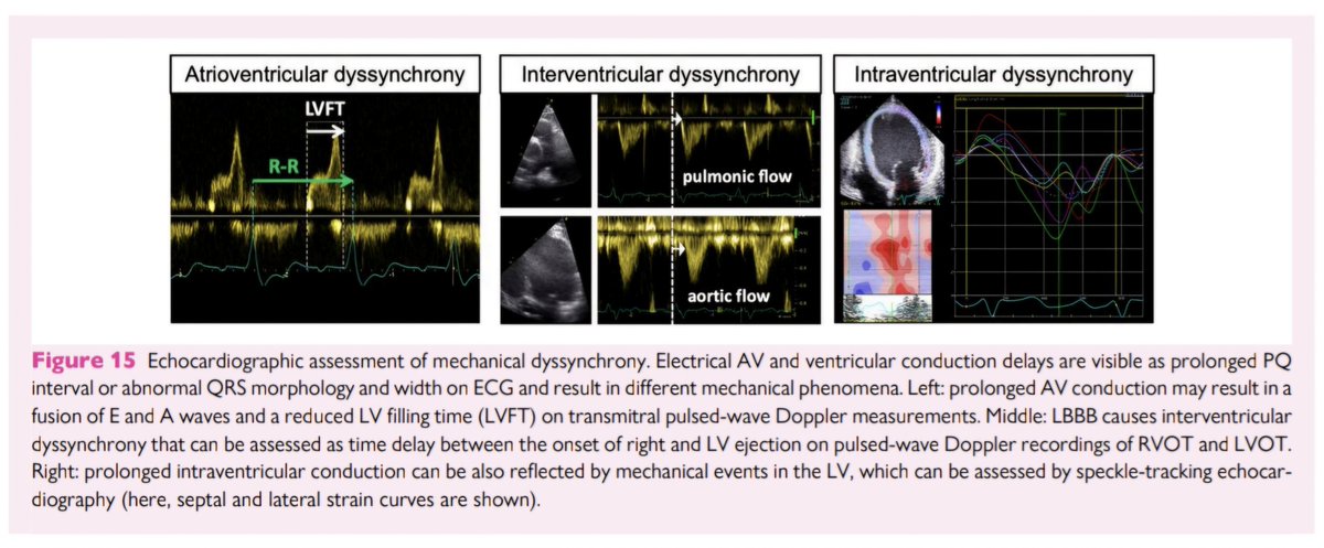 javier20ch's tweet photo. Disincronía mecánica ventricular por ecocardiografía. 🫀💥⚡️
🟥La disincronía mecánica representa la pérdida de coordinación temporal de la contracción ventricular secundaria a un retraso en la conducción eléctrica. Puede evaluarse en tres niveles: auriculoventricular, interventricular e intraventricular.
🔺️ Disincronía AV: el retraso de conducción AV compromete el llenado del VI, reduciendo precarga y volumen sistólico. En Doppler mitral puede observarse fusión de las ondas E y A y acortamiento del tiempo de llenado. Un tiempo de llenado del VI <40% del ciclo cardíaco indica disincronía AV significativa.
🔺️ Disincronía interventricular: corresponde al retraso entre la eyección del VD y VI. Se mide con Doppler pulsado calculando la diferencia entre el inicio del flujo en TSVD y TSVI. Un retraso >40 ms se considera significativo (por sí solo no predice adecuadamente la respuesta a TRC).
🔺️ Disincronía intraventricular: describe la contracción/deformación descoordinada entre diferentes regiones del VI. En el BRIHH, el septo se activa precozmente mientras la pared lateral lo hace tardíamente; posteriormente, la contracción lateral estira al septo, generando una distribución anormal del trabajo miocárdico y deteriorando la eficiencia ventricular (septal flash y apical rocking).

📝🆓️⤵️ @ESC_Journals 🔥💯
https://t.co/g9epHJDjFB
https://t.co/xvbw4nxC8H