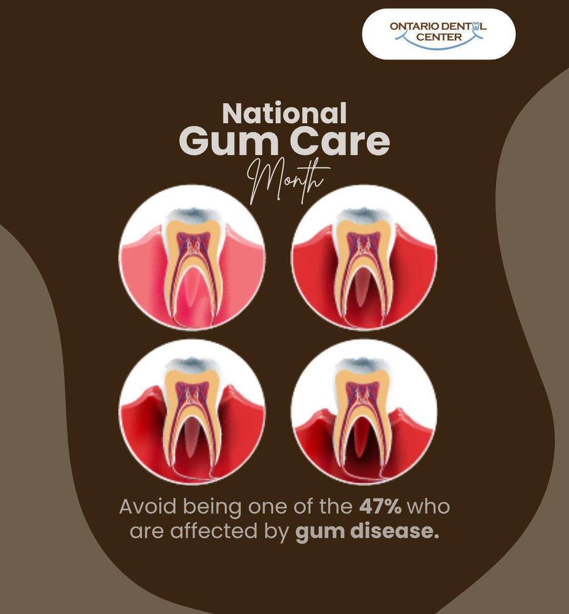 ONDentalCenter's tweet photo. Around 47 percent of Americans suffer from gum disease. If left untreated, gum disease can lead to severe consequences that affect your oral health. Book an appointment today to protect your oral health.
.
.
.
https://t.co/TI6jE5JdWZ
.
.
.
#gumdisease #gumcare https://t.co/Kv5Ybbtx1p