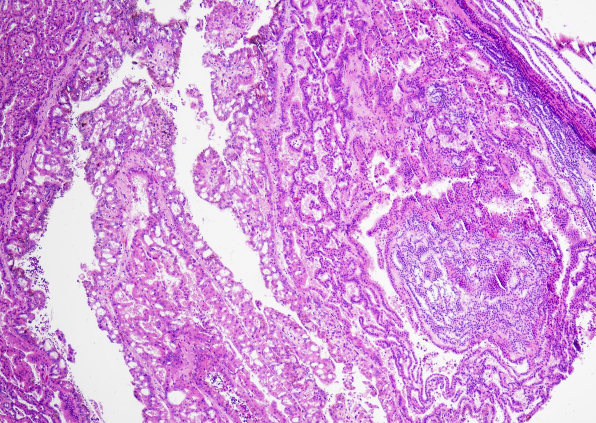 GuannanTiffany's tweet photo. 🧩 Kidney  riddle

One of my favorite case, a true diamond in all the treasures I have collected.

Let us start simple: how many tumors can we see?

#DxMindMap #KidneyPath #GUPath #PathTwitter @JHUpath https://t.co/gSSpLbZvYS