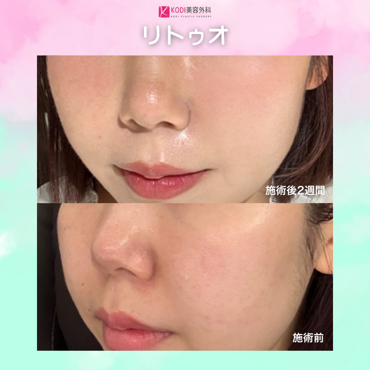 kodipsjp's tweet photo. 💖KODI美容外科💖

✨リトゥオ症例✨

肌にハリとツヤをプラスして、なめらかで健やかな印象へ💉
肌質を整えたい方におすすめの肌育治療です💖

🔗お問合せはプロフィールの公式LINEへ💁‍♀️
#韓国美容 #リトゥオ https://t.co/jX5ZTXNNzl