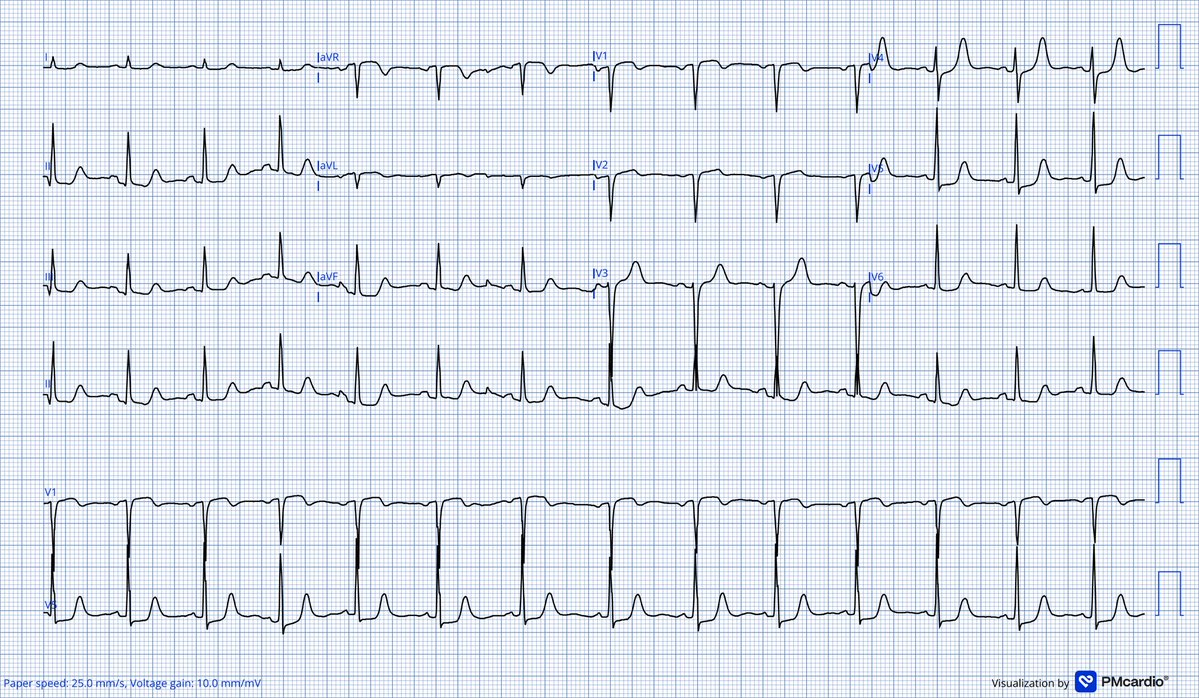 shakilED's tweet photo. 56 year old with palpitations and shortness of breath. https://t.co/zdLpE24uSG