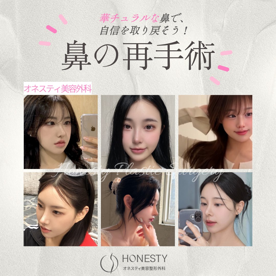 honestyps_jp's tweet photo. 鼻の再手術、今度こそ自分に似合う鼻へ👃🏻✨

高さだけでなく、鼻筋・鼻先・小鼻のバランスまで。
自然さ＋華やかさの「華チュラル鼻」🌸

韓国・新沙 オネスティ美容外科
日本語相談OK🇰🇷🩷

#鼻整形 #鼻再手術 #鼻修正 #韓国整形 #韓国美容外科 https://t.co/01mSAj4eIA