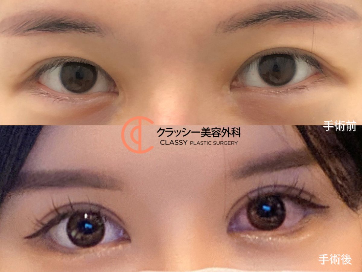 classypsjapan's tweet photo. 🧡MADE IN CLASSY🧡

奥二重から、自然な平行二重へ✨

自然な丸みを残しながら、
目元の存在感もしっかり感じられる二重ラインに✨

お問い合わせは公式LINEへ💌
#二重整形 #韓国美容 https://t.co/ccTDTJCuMO