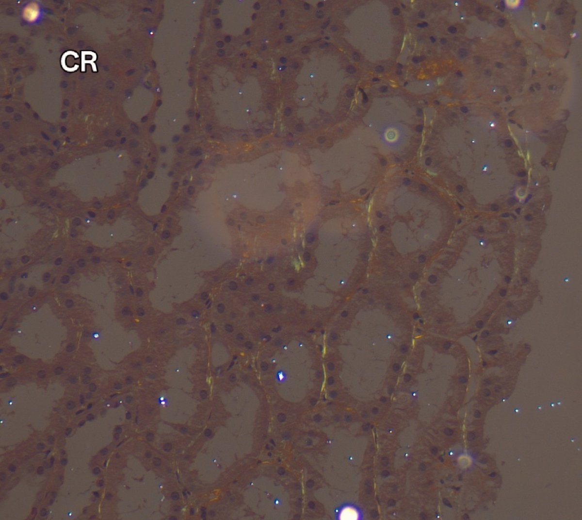 RenalPathLabs's tweet photo. Now see these two!
Primary amyloid can be extremely subtle, without DIF, you can easily miss it! PAS won't help. May miss on DIF-P! https://t.co/bUy48LHWHj