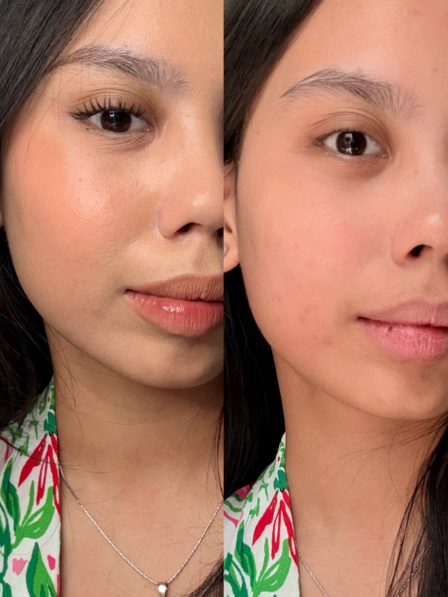 beautales_'s tweet photo. from dempul to… BERSIH BETUL 😭🕺🩷🫰

day 1 dengerin kata dokter kulit seneng banget remove eyeliner aja GUAMPANG POL https://t.co/GRcytDls1e