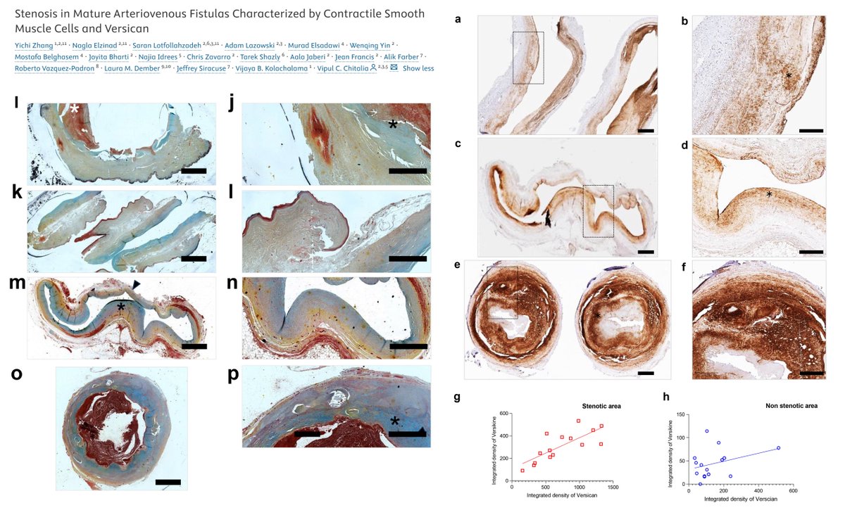 HaoYin20's tweet photo. #Dialysis
Immunohistochemical phenotyping of Smooth Muscle Cell in 👤Stenotic Arteriovenous Fistula
N=21 #EndStageKidneyDisease
High in contractile proteins
High in Versican/Versikine
High in Ki67+ proliferation
#KidneyIntRep 2026
https://t.co/7IfDgjcoDk https://t.co/AXa8B8gX8F