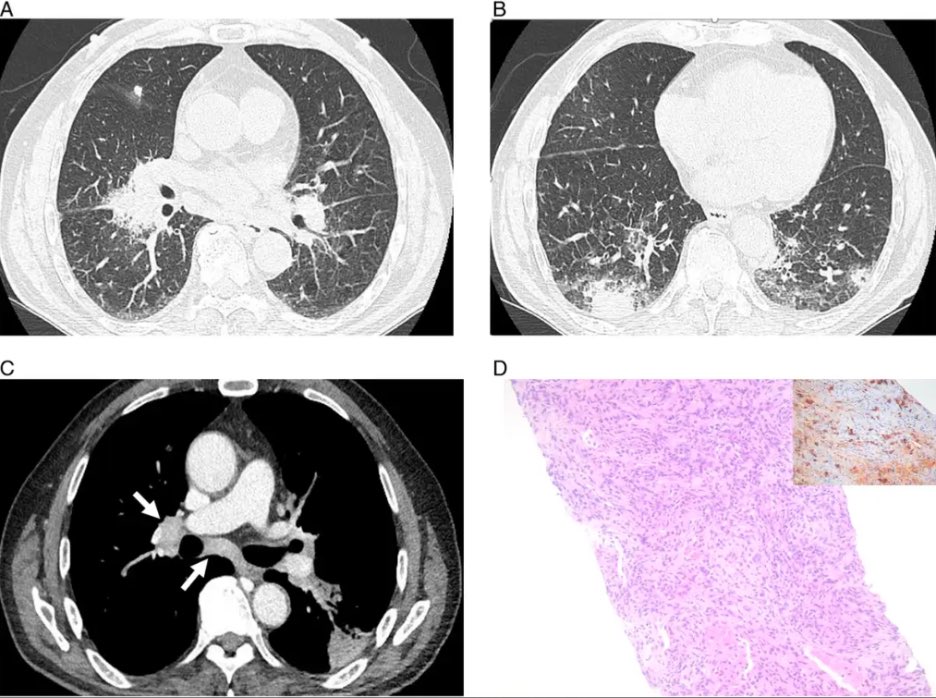 JTIJournal's tweet photo. 🫁 New pictorial essay by Kim et al in #JTI reviews 🔑 imaging features of thoracic IgG4-related disease (IgG4-RD), a chronic, immune-mediated fibroinflammantory disorder with multiorgan involvement—a true chameleon��� 

🔗 to full article in reply!

#Radiology #ThoracicImaging https://t.co/SvctvTshS4