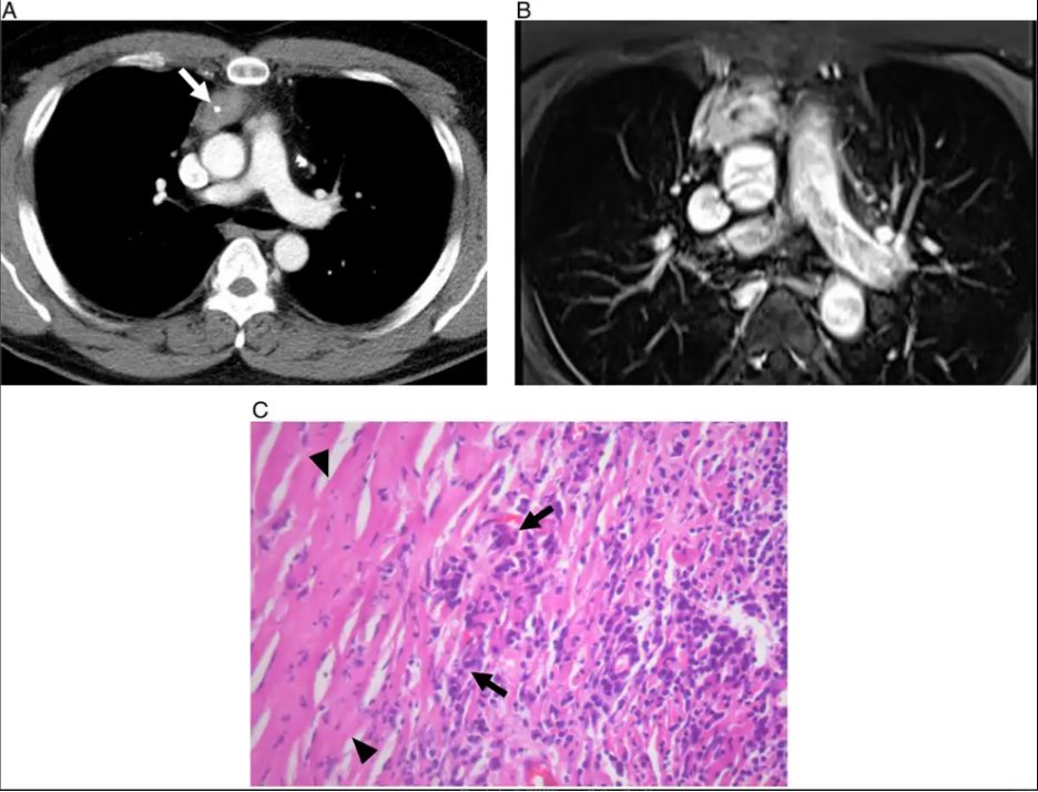 JTIJournal's tweet photo. 🫁 New pictorial essay by Kim et al in #JTI reviews 🔑 imaging features of thoracic IgG4-related disease (IgG4-RD), a chronic, immune-mediated fibroinflammantory disorder with multiorgan involvement—a true chameleon��� 

🔗 to full article in reply!

#Radiology #ThoracicImaging https://t.co/SvctvTshS4