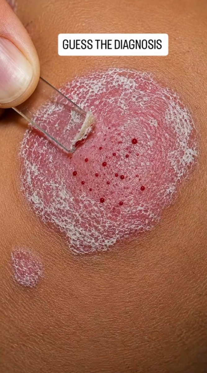 Alnumiri11's tweet photo. مريض لديه لويحة حمامية Erythematous plaque محددة الحدود ومغطاة بقشور فضية بيضاء. يحدث نزيف نقطي Pinpoint bleeding بعد إزالة القشور.  

أي علامة سريرية تم توضيحها ؟ وأيضاً خمن التشخيص. https://t.co/Nx8mpwb2ZH