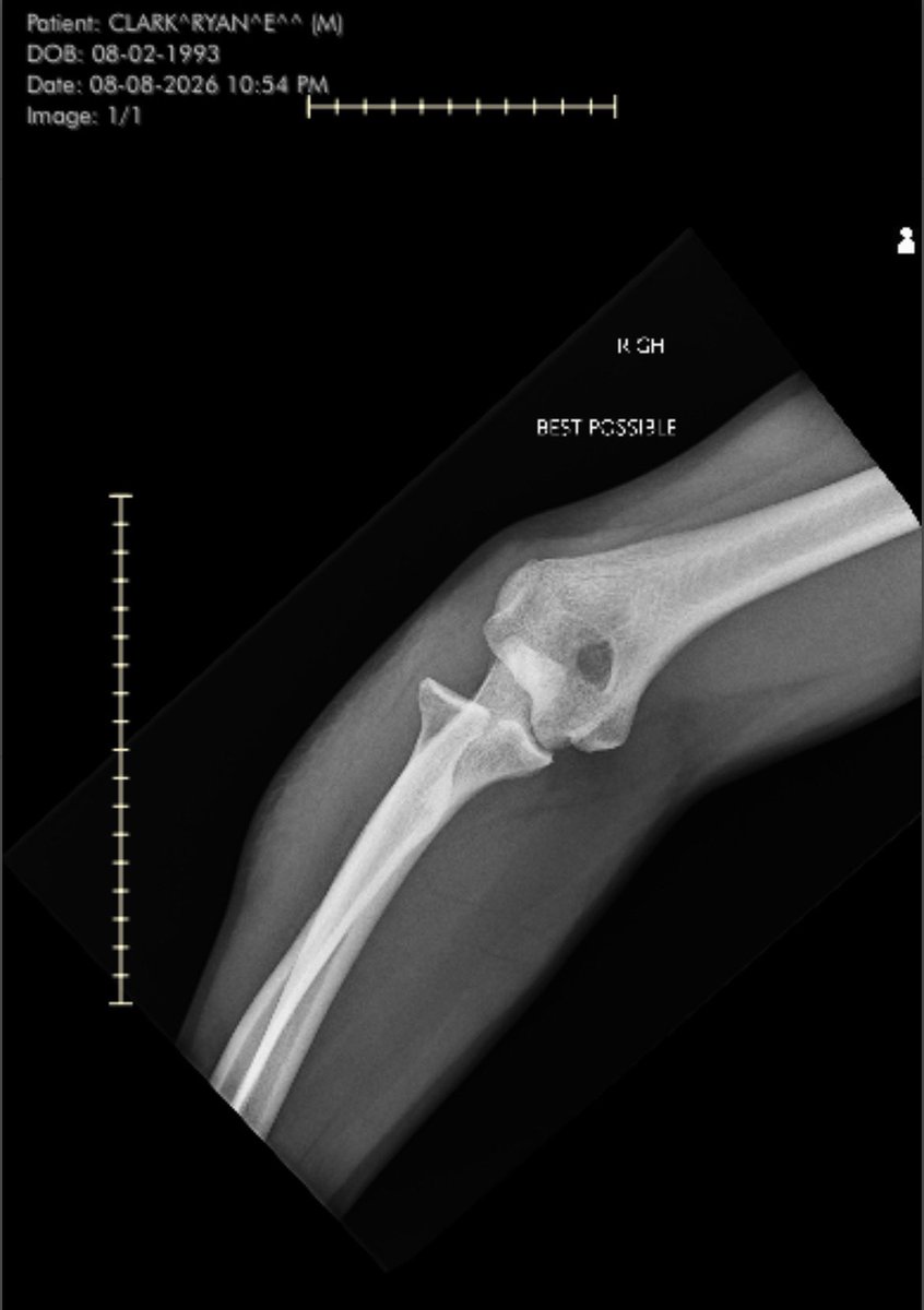 SwingerFitz's tweet photo. Surgery Monday 

- Extensor Muscle tendon torn off bone
- Lateral Capsule ruptured
- LCL completely torn
- UCL complex tear
- Broken coronoid process 
- Fractured 3 additional

See you all down the road ♥️ https://t.co/JmqdR3D3rD
