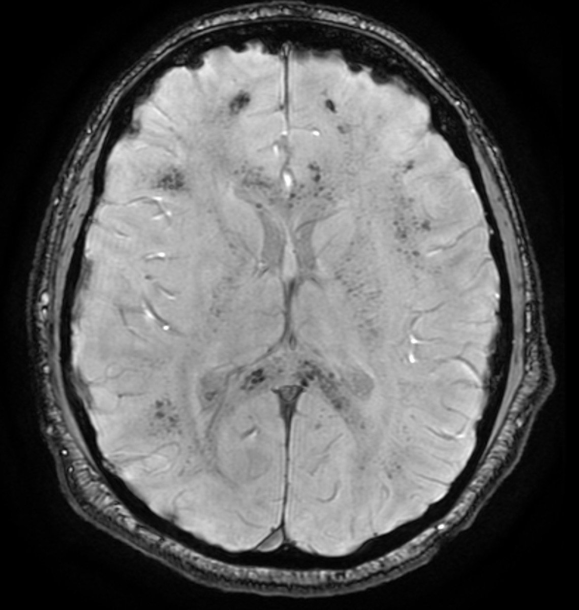 jjgarnham's tweet photo. ICU MRI. The T2-weighted images are normal but the SWI looks like iron filings scattered over a magnet. Before you think amyloid angiopathy or diffuse axonal injury, pause...

These are critical illness–associated microbleeds.

Typical pattern:

✅ Juxtacortical white matter and corpus callosum.
🚫 Cortex, periventricular white matter, basal ganglia, or thalami.
❓ Internal capsules and cerebellum.

This appears up after respiratory failure, ARDS, prolonged ventilation, or ECMO, not after a fall, and not only in the elderly. Fat embolism is the main radiological mimic but comes with a "starry sky" DWI pattern.