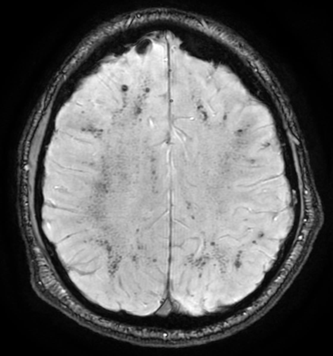 jjgarnham's tweet photo. ICU MRI. The T2-weighted images are normal but the SWI looks like iron filings scattered over a magnet. Before you think amyloid angiopathy or diffuse axonal injury, pause...

These are critical illness–associated microbleeds.

Typical pattern:

✅ Juxtacortical white matter and corpus callosum.
🚫 Cortex, periventricular white matter, basal ganglia, or thalami.
❓ Internal capsules and cerebellum.

This appears up after respiratory failure, ARDS, prolonged ventilation, or ECMO, not after a fall, and not only in the elderly. Fat embolism is the main radiological mimic but comes with a "starry sky" DWI pattern.